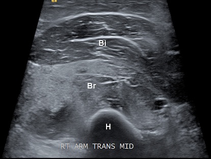 Figure 4 for case Acute rhabdomyolysis